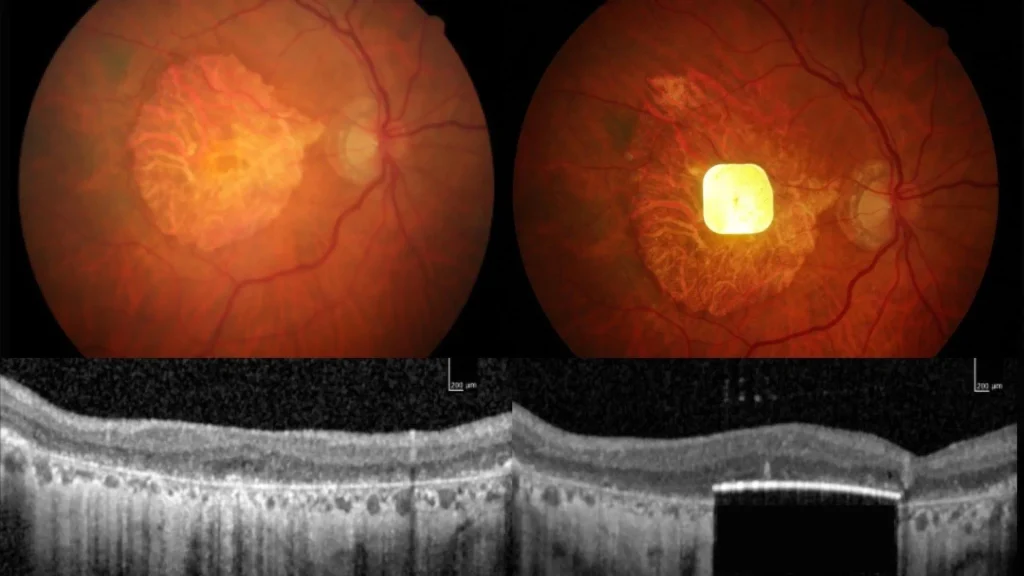 Tiny AI-powered eye implant helps the blind see again